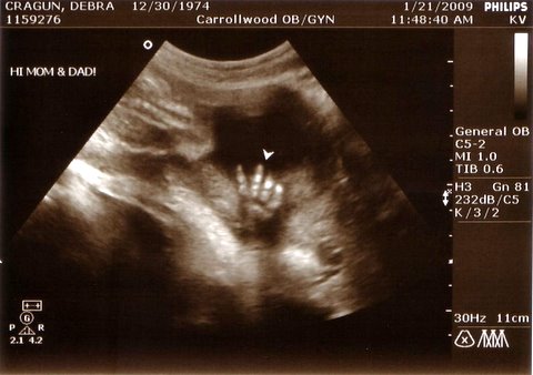 Ultrasound Determine Sex Of Baby 28
