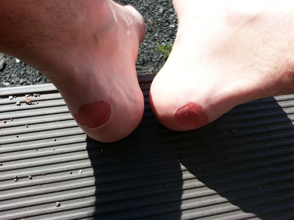 heel blisters - 2012-07-09T17:36:18
